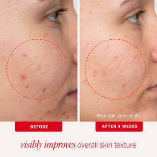 Ultimate Acne Solutions Routine