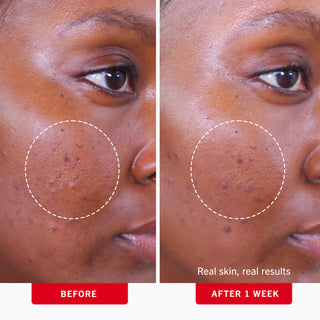 Acne Clearing Pads with 2% Salicylic Acid