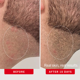Ingrown Hair Pads with BHA + AHA 60 count
